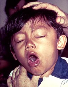 whooping-cough